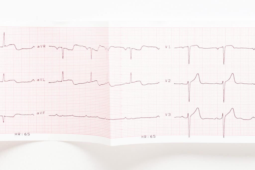 Cara Menghitung Heart Rate