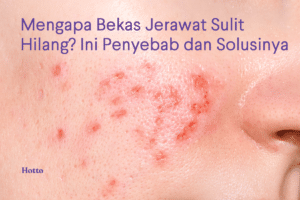 Mengapa Bekas Jerawat Sulit Hilang Ini Penyebab dan Solusinya