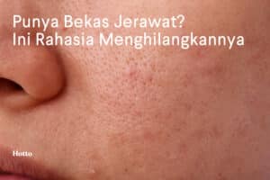 Punya Bekas Jerawat Ini Rahasia Menghilangkannya
