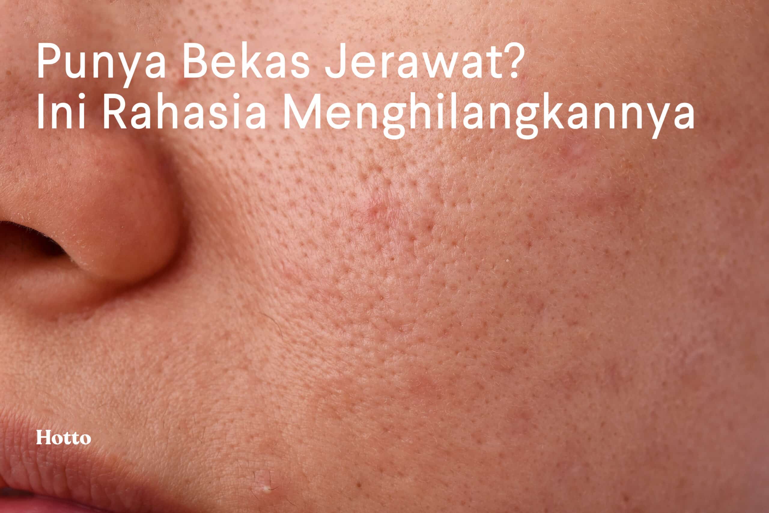 7 Nutrisi Yang Bantu Hilangnya Bekas Jerawat